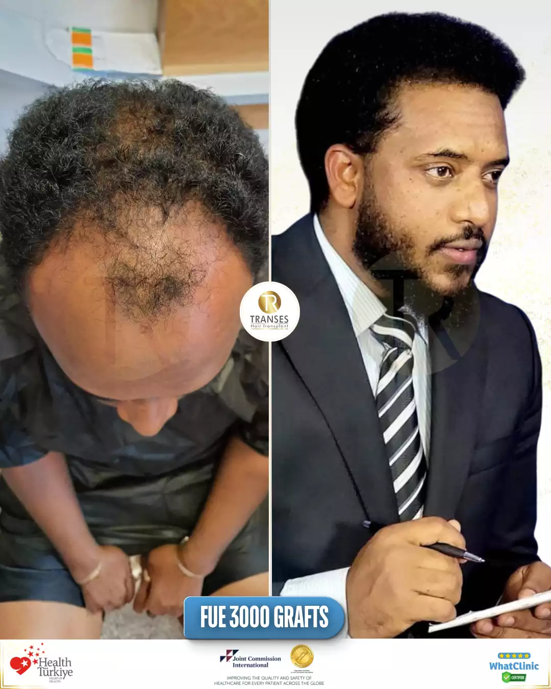 Afro Hair Transplant
