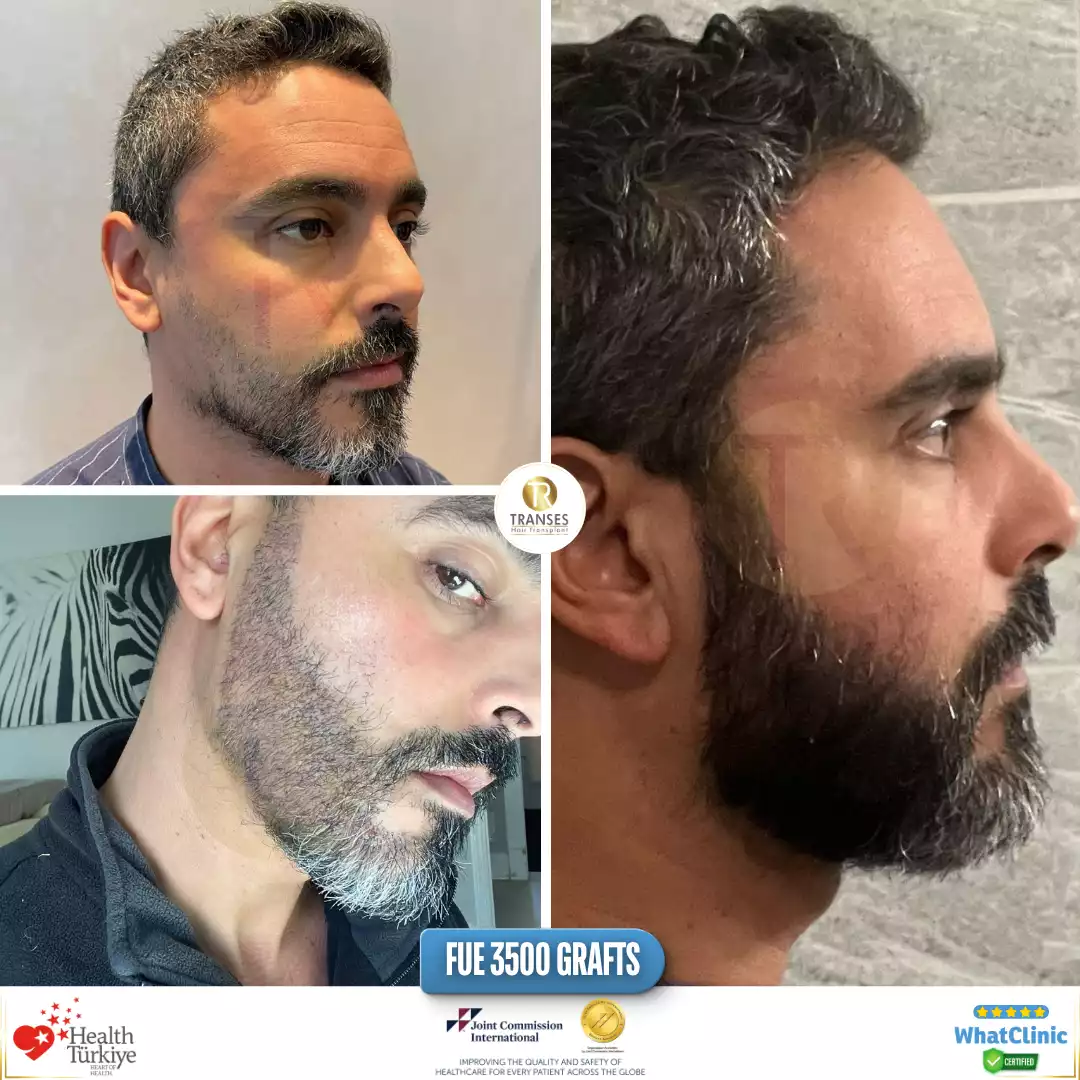 Beard Transplant