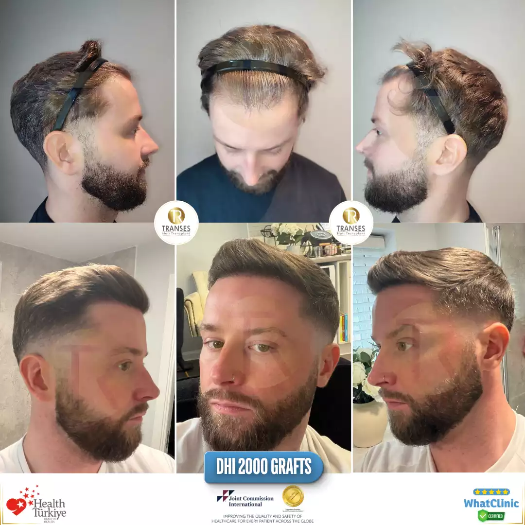 DHI Hair Transplant 