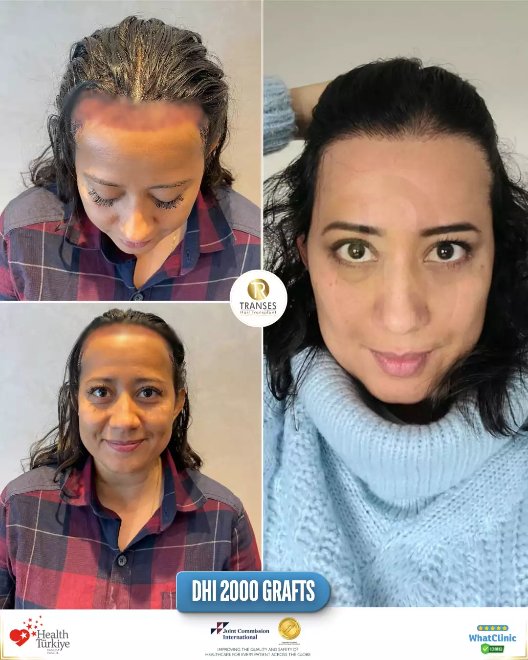 DHI Direct Hair Transplant 
