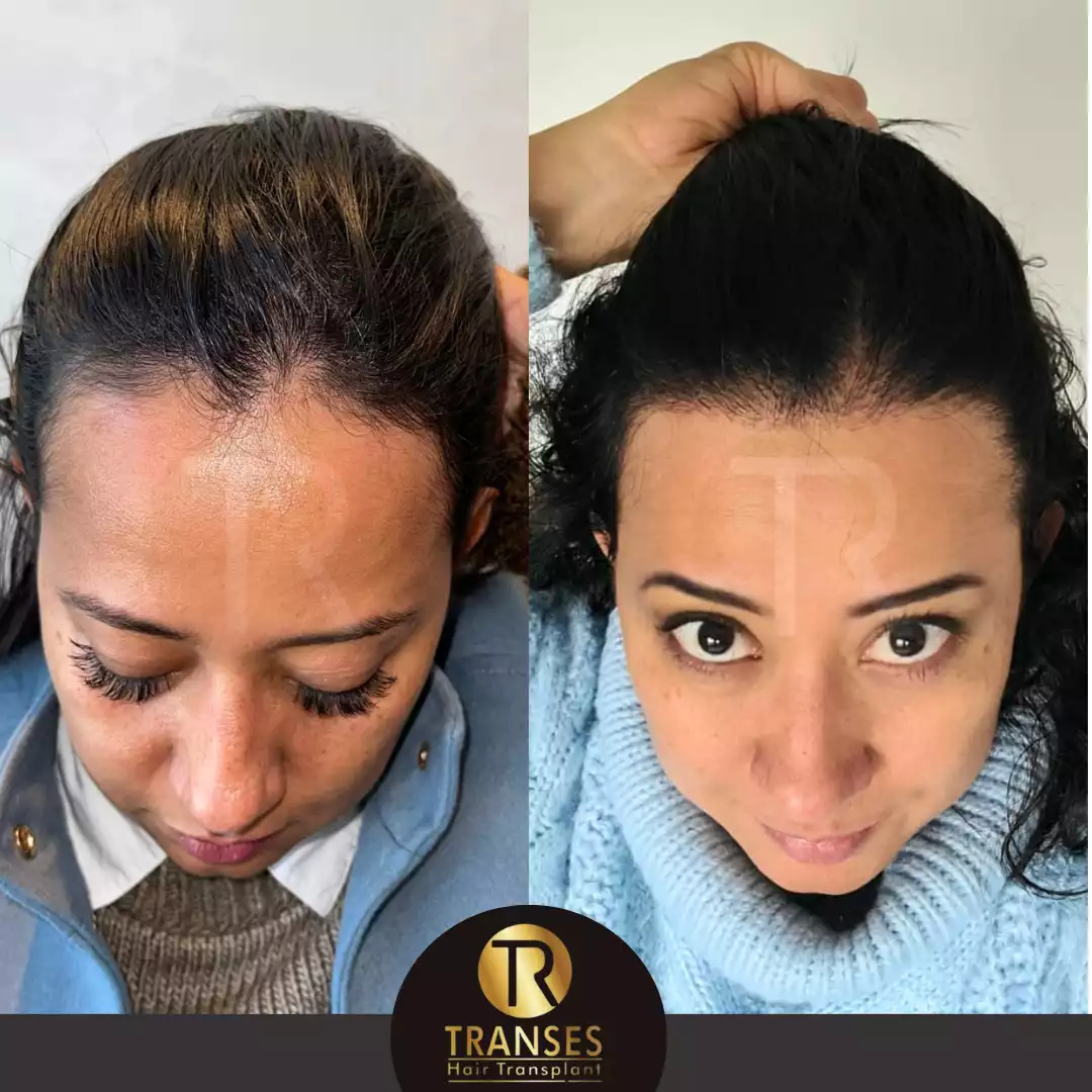 Hair Transplant for Women
